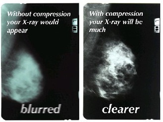 Mammograms: What They Dont Tell You.
