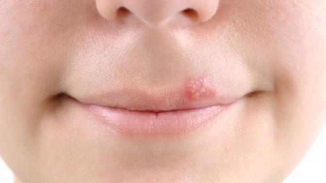 How to stop a cold sore in its tracks