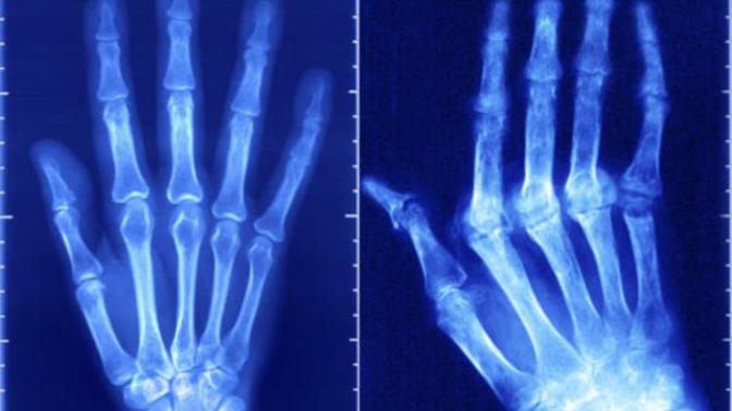 Autoimmune Disease: Living with RA
