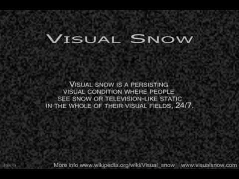 Visual Snow----Statics in My Vision 24/7