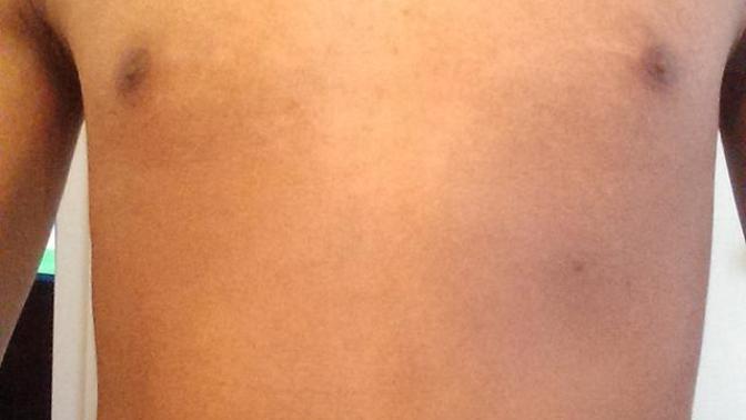 Girls, How can I get my skin tone even again? (Pics)?