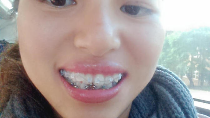 How soon will your teeth start straightening out after having braces put on?