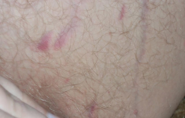 What can I do about my stretch marks?