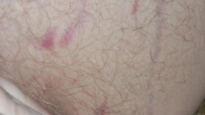 What can I do about my stretch marks?