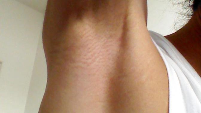Girls, I am 22 yearas old college male. I got laser hair removal on my armpits. What do you think?