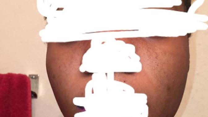 Is it black head or something else?
