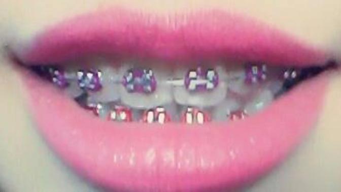 Does braces hurt when u get them?