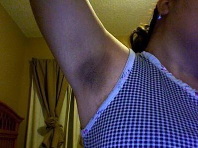 Is dark stained underarms a deal breaker for anyone else or am I just being shallow?