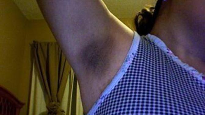 Is dark stained underarms a deal breaker for anyone else or am I just being shallow?