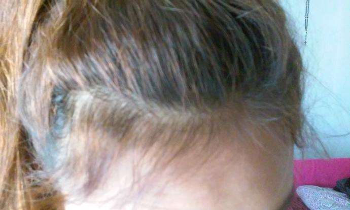 Girls, Am I thinning hair or losing hair (pictures included) help?