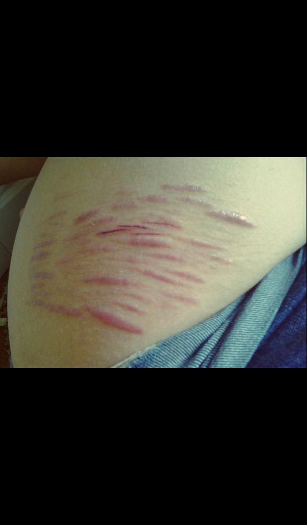 Will my scars stay this way forever?