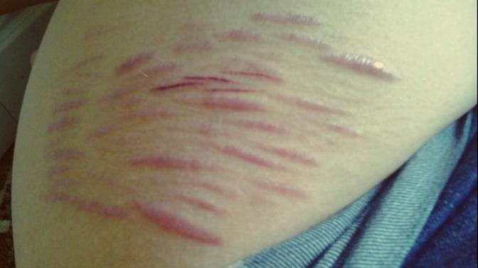 Will my scars stay this way forever?