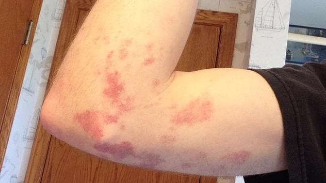 Are birthmarks a turn off?