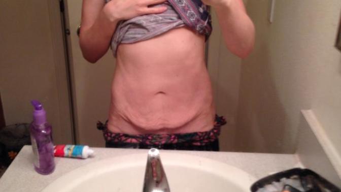 How to get rid of "mothers apron" or extra skin?