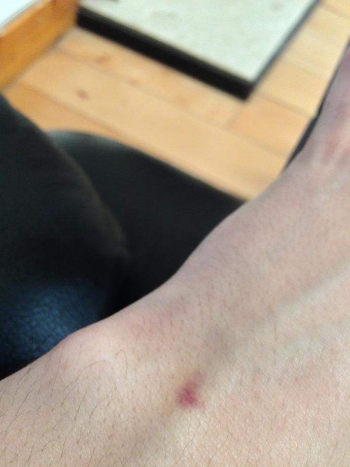🌟🌟🌟 Does anyone know what this is on my Vein? 