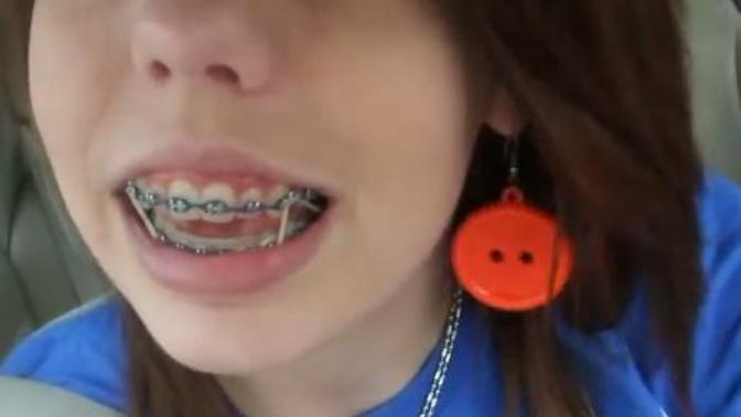 How bad do my braces look when I smile?