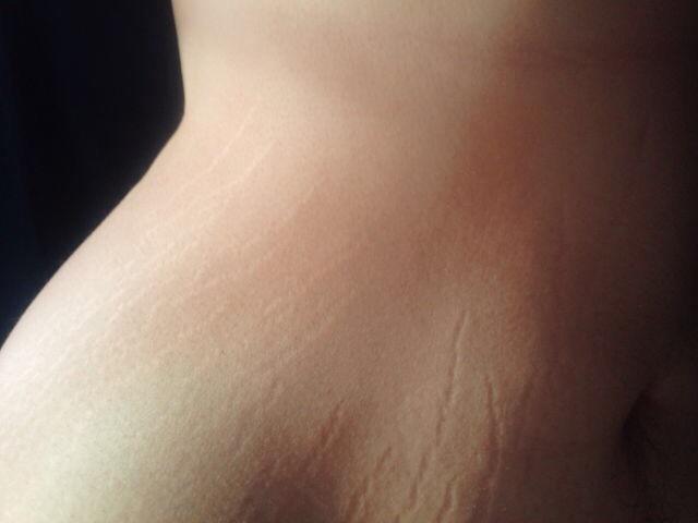 Guys, do you care about stretch marks on a girl?