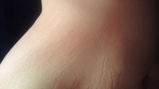 Guys, do you care about stretch marks on a girl?