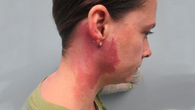 Would you date somebody with a port wine stain?