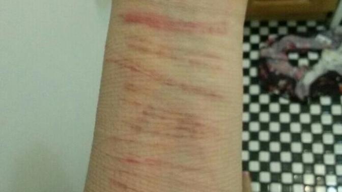 How do guys feel about girls with self harm scars? How would you feel if you saw these on your girlfriend? Would you leave her or think she's psycho?