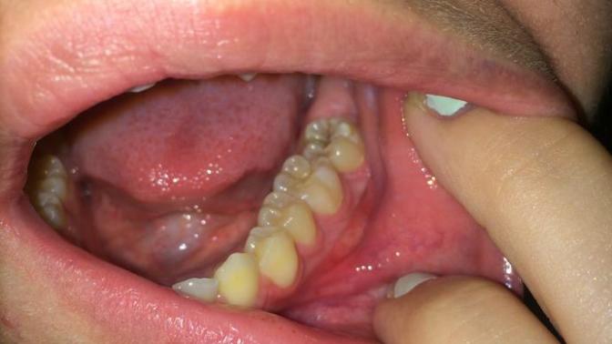 Dentists answer? Why does my bottom left gum hurt when pressure is applied? Please help? Nothing rude?