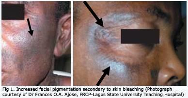 What do you guys think about girls who skin bleach, and the affects that skin bleaching can have?