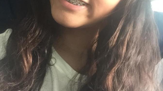 Do my braces look bad?