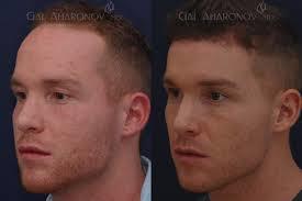 Is my forehead to big? If so do you think forehead reduction surgery would make me look more attractive?