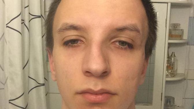 Is my forehead to big? If so do you think forehead reduction surgery would make me look more attractive?