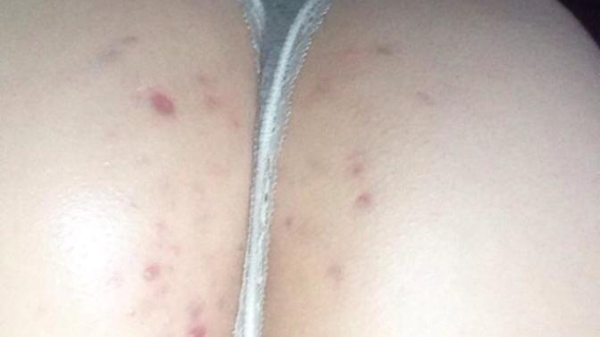 Acne scars on my butt?