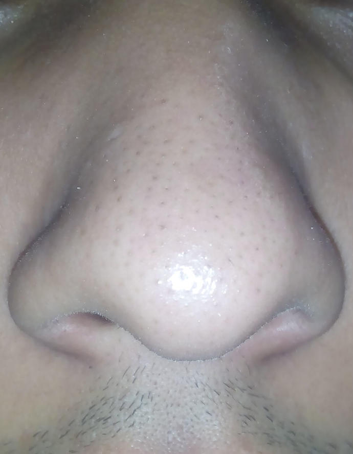 What are these black dots in my nose?