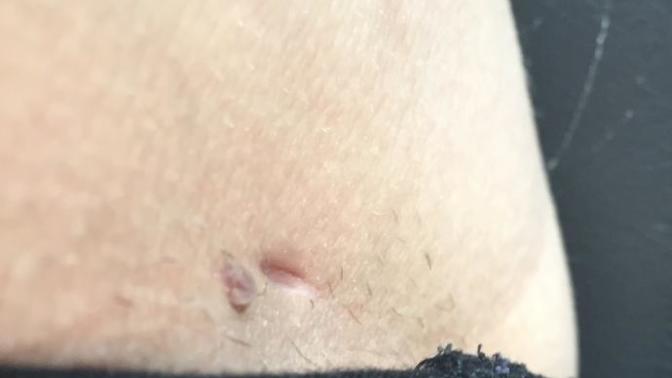 Girls, what's this indention? Yes that's stubble. Don't judge it's right by my vaginal area and has been there for a lot while?