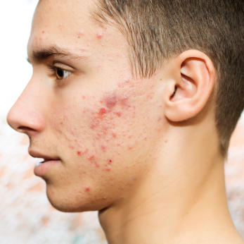 Does facial acne bother guys?