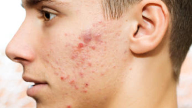 Does facial acne bother guys?
