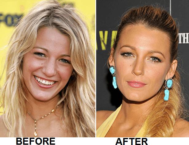 Guys: opinions on girls who've had plastic surgery?