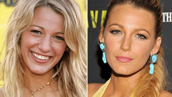 Guys: opinions on girls who've had plastic surgery?