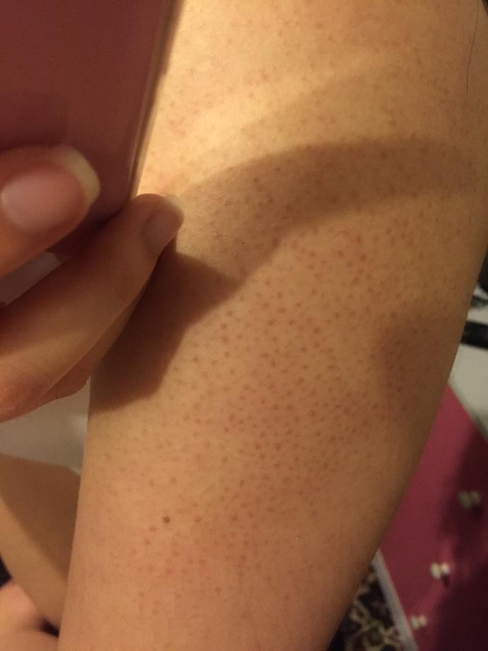 What are these red dots on my arm? And how to get rid of it?