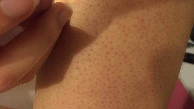 What are these red dots on my arm? And how to get rid of it?