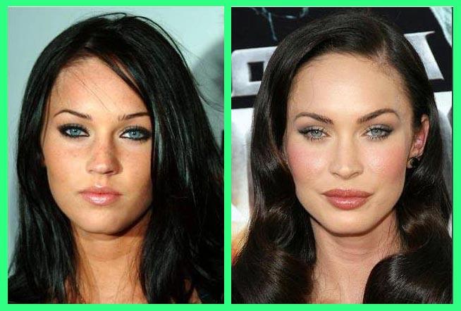 Megan Fox before or after surgery?