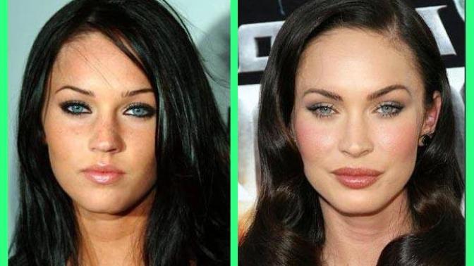 Megan Fox before or after surgery?