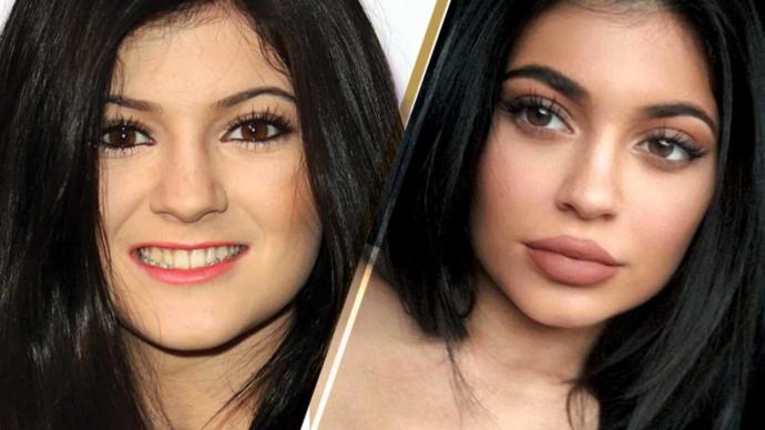 kylie jenner before and after lip surgery