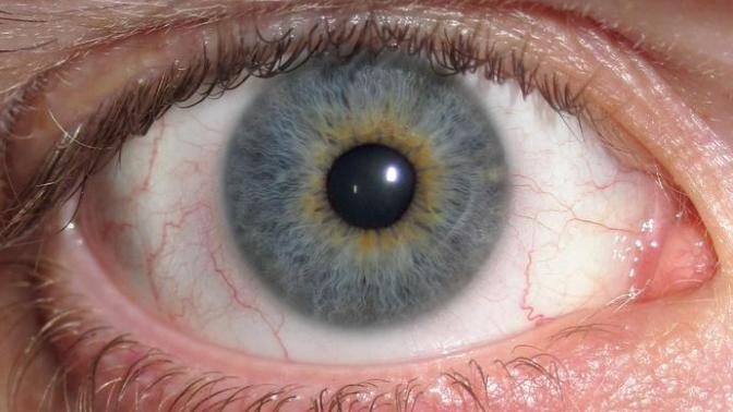 Do you have heterochromia?