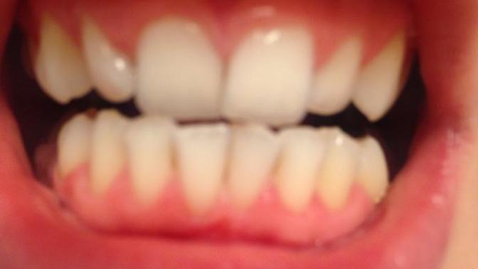 Are my teeth a complete and uter deal breaker?