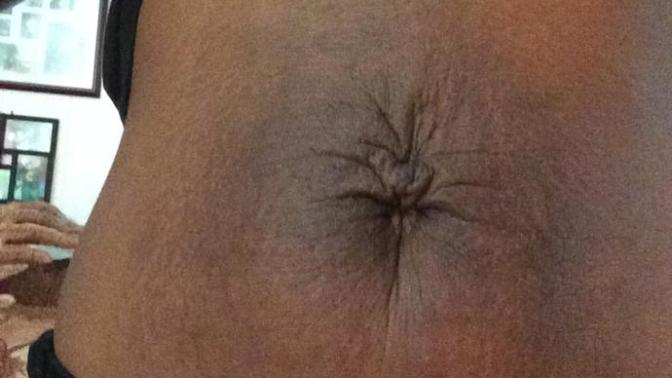 Wrinkly belly button/loose skin on petite girl turn off?