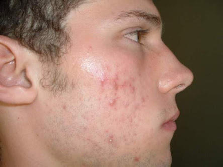 Girls, If a guy has acnes(see pic) does it make any difference to you?