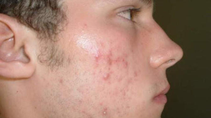 Girls, If a guy has acnes (see pic) does it make any difference to you?