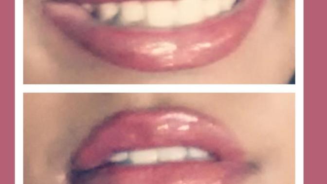 How are my new lips?