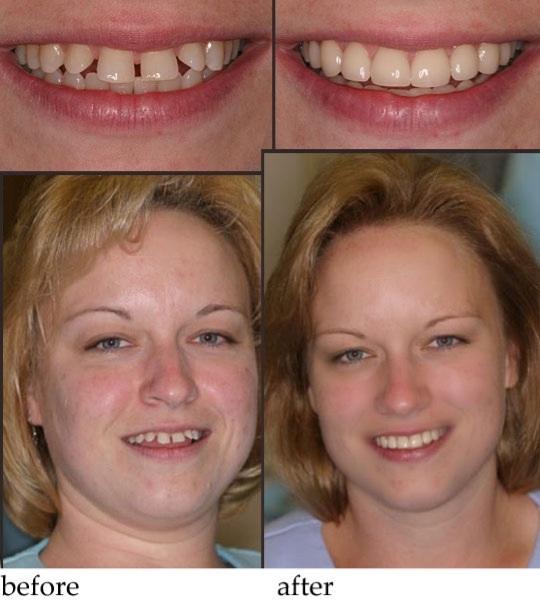 the power of braces and some good makeup?