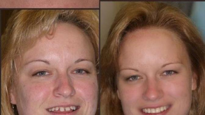 The power of braces and some good makeup?