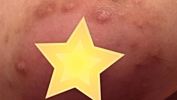 Scarred nipples, disgusting or you wouldn't notice?